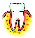 Gum Disease progress animation