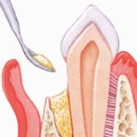 Periodontal bone graft